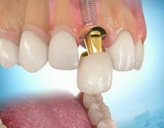 Cirujano dentista Especialista en Rehabilitacion Bucal, Cirugia Estetica e Implantologia Oral