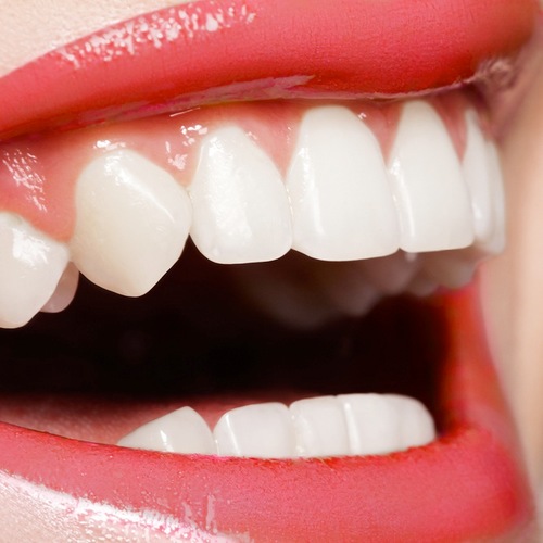 Wholesale priced at home teeth whitening with the fastest, most effective results available today.
