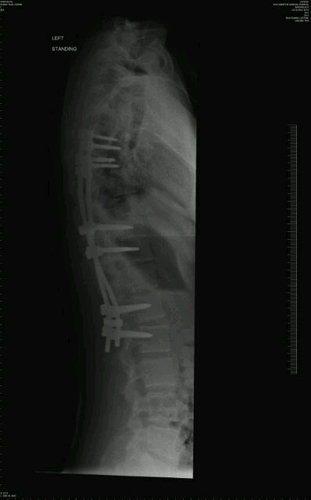 I am 20 & diagnosed with scoliosis. This is the documentation of my surgery (08-11-12) for myself & anyone else who can advise/relate to/is interested in it