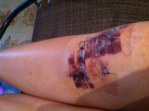 ACLstruggles's profile picture. Those post-surgery everyday struggles of an ACL tear