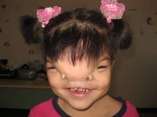 The LovingFaces campaign provides children around the world born with terrible facial deformity, free life-changing surgery.
