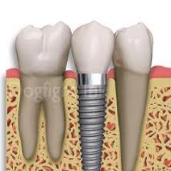 Implantologia, Periodoncia, Microcirugia