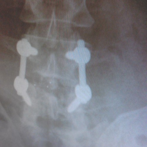 Just recovering from getting that cool hardware in the photo installed in my spine!!!