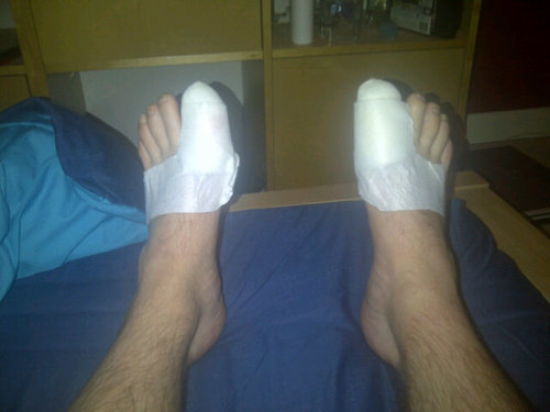Frostbite didn't get my toes!