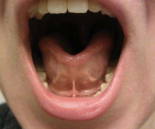 Formerly tongue tied woman encouraging others to get treatment for their #ankyloglossia. If #MyofunctionalTherapy was a boy band, I'd never stop fangirling!