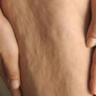 Selulit Selulitliyim Twitter