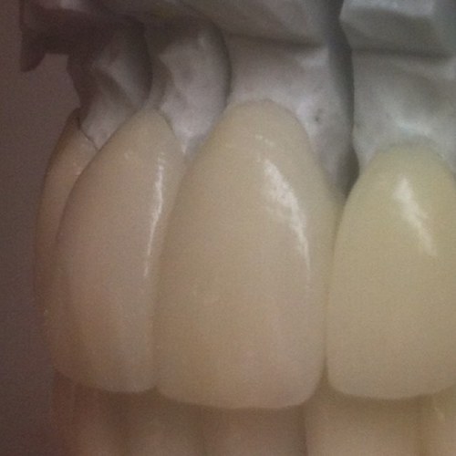 Straumann CADCAM Implant Dental Laboratory, cosmetic, eMax, diagnostics.
