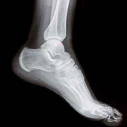 We provide all necessary information on Charcot Marie Tooth Disease and its medical management options.