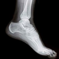 CharcotMarieTooth (@charcotmariet) 's Twitter Profile