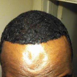 Go from Bald to hair within hours with no surgery and have real hair!! This is not hair fibers!! This is 100% real hair this is not a scam.
