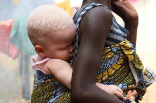 The RiadBayorFoundation strives to fulfil our vision of being a vehicle for the enhancement and transformation of the lives of ALBINOS