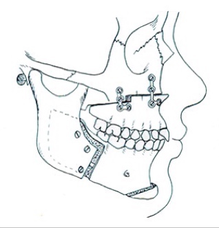 • I tweet about Oral & Maxillofacial Surgery..

• Contributions from surgeons are highly appreciated..

• My topics: http://t.co/AcgmqLlmCr
