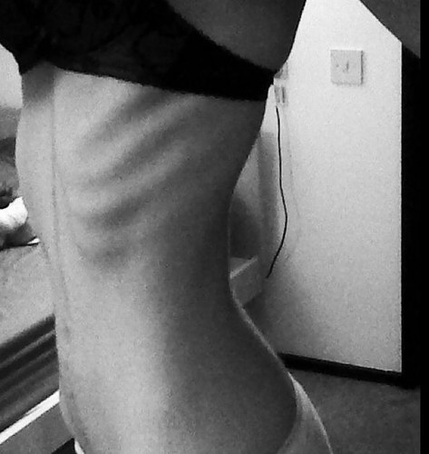 Bulimia / gw: 120 / cw: 143 ht: 5'9