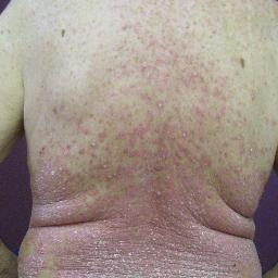 Psoriasis since 1979. Psoriatic arthritis 1991. RA in knees 2004. Osteoporosis 2011. Attended Waiheke District High School.