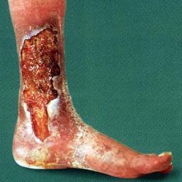 cirujanolds's profile picture. Cirujano Cardiovascular y General. Especialista en Ulcera Varicosa, pie Diabético, Enfermedad arterial Obstructiva, Linfedema,