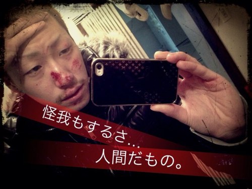 怪我だってするさ。人間だもの…。