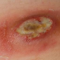 Boils may form individually or be grouped together. When multiple boils fuse together to become one lump, the resulting lump is called a carbuncle.
