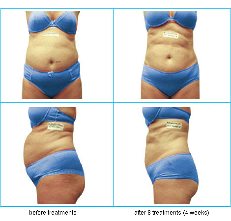 Loose 2-6cm in 20 min. Safe & Painless. Medically approved. Instant Results Guaranteed