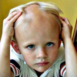 healing autoimmune alopecia areata through microbiotic combination therapy.