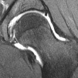 FAI Hip Impingement Awareness, FAI Hip arthroscopy, FAI Hip surgery, FAI Hip rehab, FAI Hip physio, FAI Hip support group, FAI Hip best surgeons group