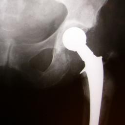 The latest news and information regarding Stryker hip replacement lawsuits. Sponsored by Hissey Kientz, LLP.