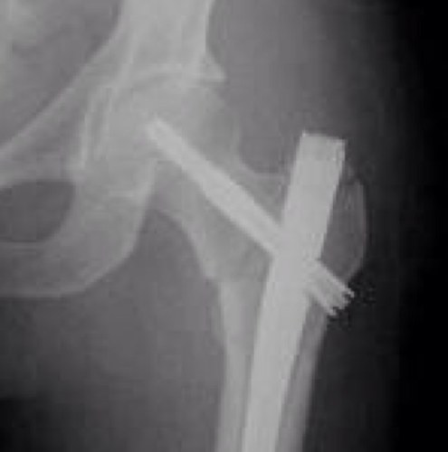 A weekly OrthoCase compiled by trainees for education & discussion. Expert comment gratefully received. All cases and imaging anonymised.