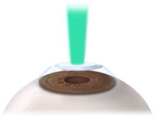 Referral Avenues for Opticians and Laser Vision Correction providers.