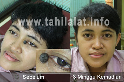 KlinikTahiLalat's profile picture. Tempat Menghilangkan Tahi Lalat (Tompel) secara alami,AMAN! Tanpa Operasi/laser & Harga Terjangkau. Lokasi di Teluk Gong. (021)31739988 PIN BB: 33043787.