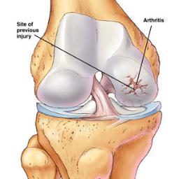 Arthritis guide and tips.