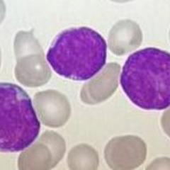 Lymphoma Leukemia