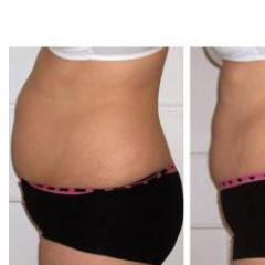 LaserLipoNR31's profile picture. Laser Lipo are machines that offer the shortest inch-loss treatment times! Call to find out how we can help with your weight loss. 01493 301 212 / 07717 497 083