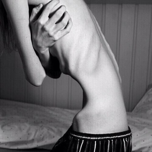 CW: FAT UGW: 80lbs | 18 years old, diagnosed anorexic for 3 years.