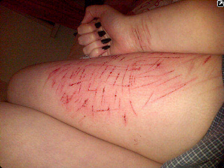 #SelfHarm bracelets, Secrets & Scars.