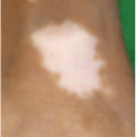 United4Vitiligo (@united4vitiligo) 's Twitter Profile