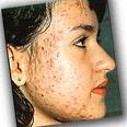 acne, pimples, scars, skin care, beauty