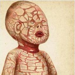 harlequininfo's profile picture. A informational hub about Harlequin Ichthyosis for the parents of harlequin baby and general public.