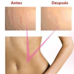 Recibe los mejores consejos para prevenir las #estrías y conoce los mejores productos para eliminarlas. elimina_las_estrias@hotmail.com