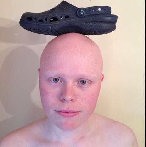 just things on a bald guys head.
