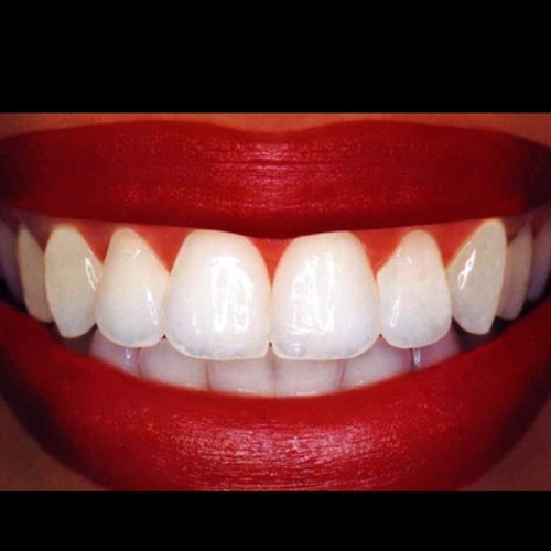 Tooth whitening fairy x