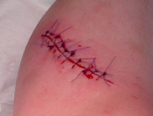 Shit happens always to fuckin me (sliced my leg open)