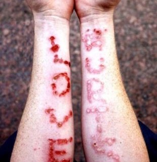 Can't stand the way people look at the burns on my arms. I do it to myself and I'm not a freak...