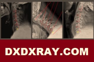 DIGITAL X-RAY DIGITIZER ( DXD ) SOFTWARE
DXD correlates with AMA Guidelines to quantify Ligament Laxity 728.4 and provides evidence based objective documents.