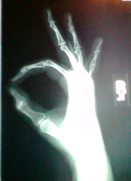 Self-absorbed in Paradise. Profile is not a white supremacist gesture; it's a cool x-ray of when I fell down 13 stairs and only broke my little finger. ;-)