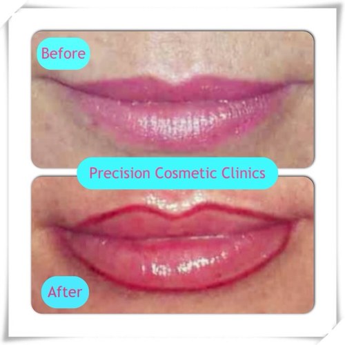 Celebrate Precise Permanent Make Up, Tattoo Removal & Meso Vytal Therapy in Hertfordshire. Harley Street Trained Technician Kally Moorhouse