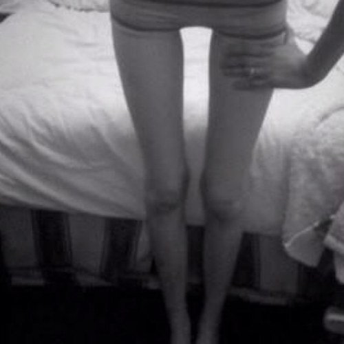 Ednos BED self-harm OCD. I'm going to be a perfect barbie. They put me in 'recovery' and I got really, really fat. 6'0 CW 204.4 GW1: 199.0 GW2: 185.0 GW3: 170.0