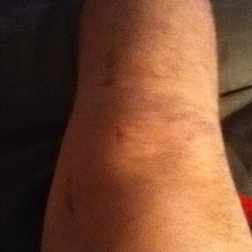 TeamTornACL's profile picture. Opinions/Advice from a male, multi-sport athlete, who has torn his ACL, MCL, and meniscus. Questions? Just ask.