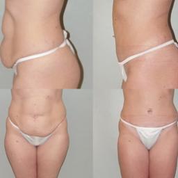 #Abdominoplasty (tummy tuck)