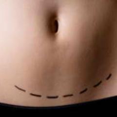 Top Tummy Tuck