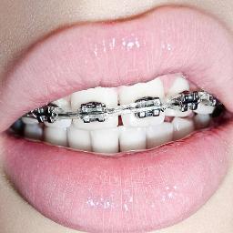 The fastest growing community for photos and videos of cute girls with braces. Submissions welcome. Braces are beautiful.