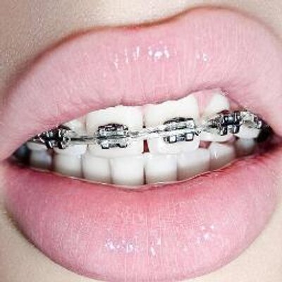 Jail bait gif braces agree, very Really. was Jail bait gif braces